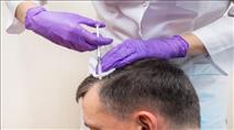 השתלת שיער DHI: שיטה מתקדמת שפותחה משיטת FUE