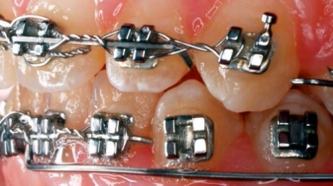 טיפול שיניים חינם עד גיל 14