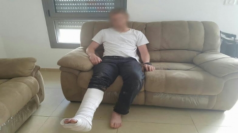 עמונה: שבר את רגלו מאלימות שוטרים